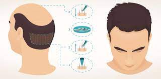 hair transplant standards, Saç Ekim Hizmeti Standartları
